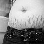 How To Get Rid Of Ugly Stretch Marks
